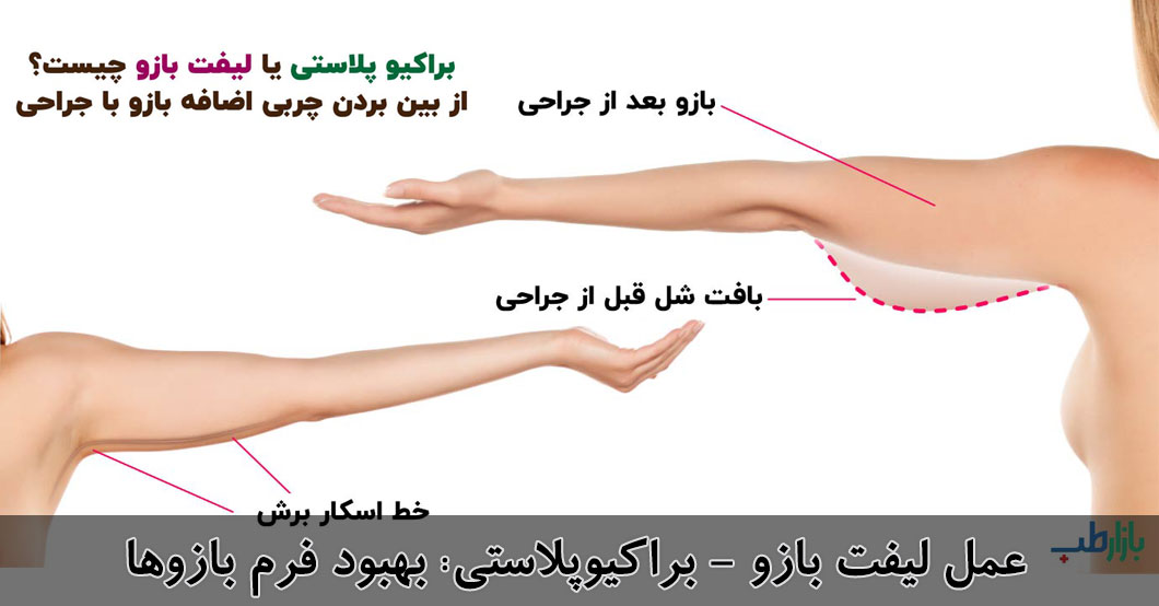 عمل-لیفت-بازو-یا-براکیوپلاستی-بهبود-فرم-بازوها1