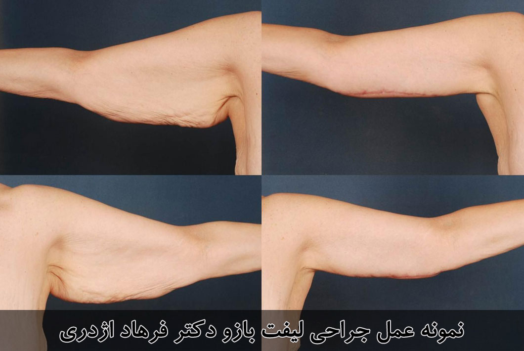 عمل-لیفت-بازو-یا-براکیوپلاستی-بهبود-فرم-بازوها