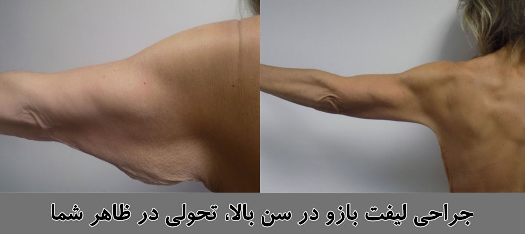 عمل-لیفت-بازو-یا-براکیوپلاستی-بهبود-فرم-بازوها